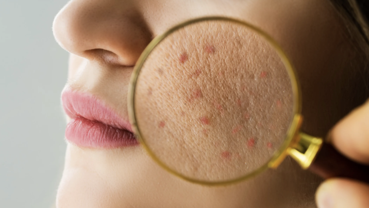 Advanced Acne Management and BLU U Acne Therapy